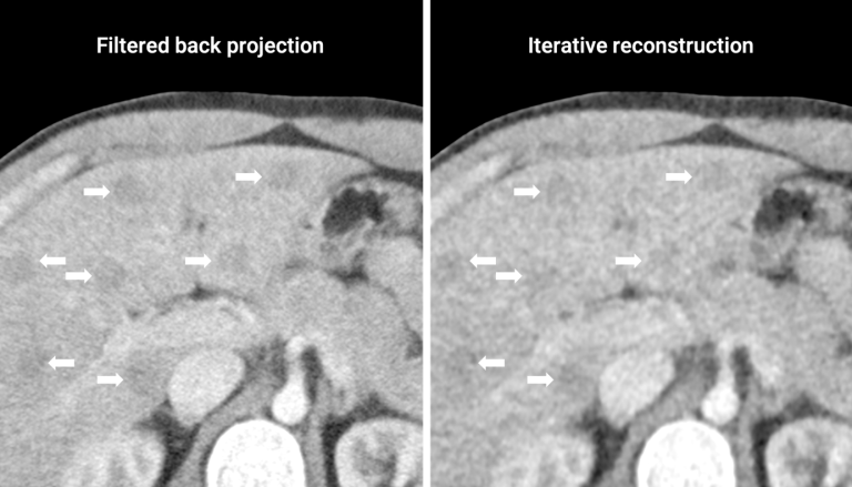 Iterative reconstruction hepatic lesion