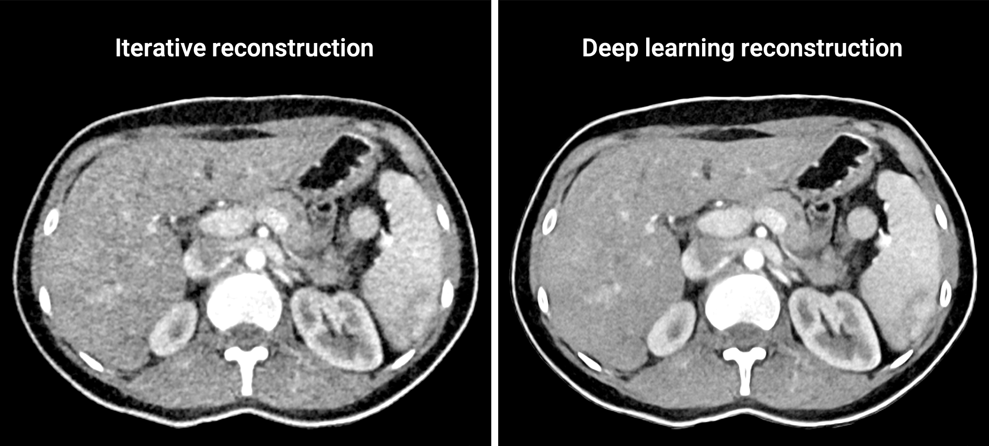 Deep learning reconstruction CT