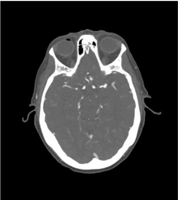 Head Phantom - CTA aneurysm