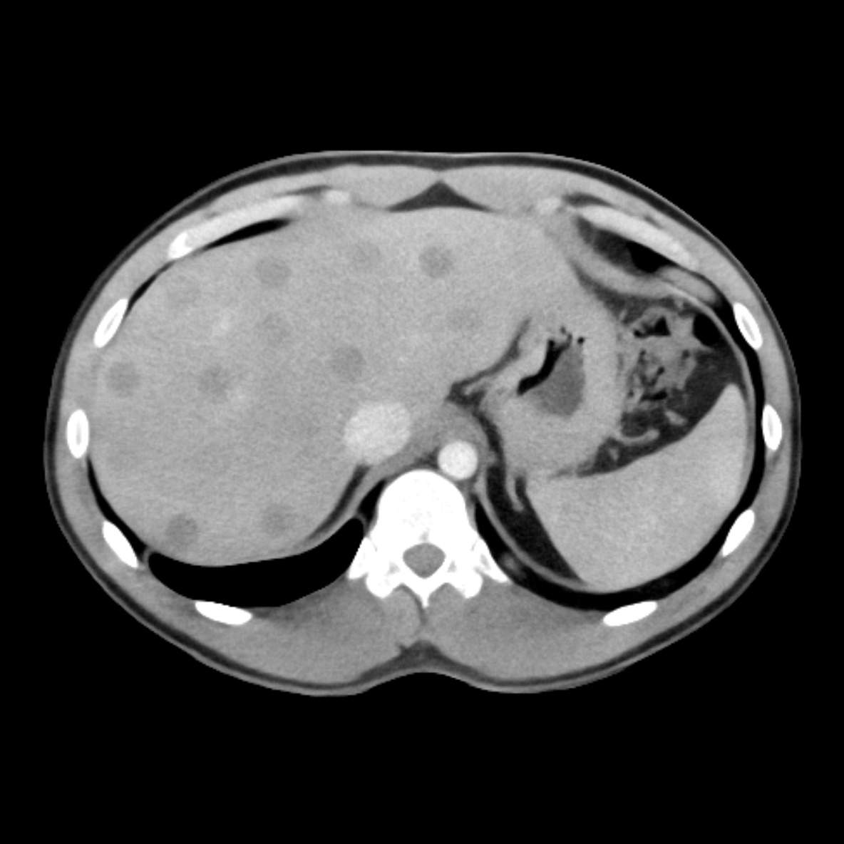 Liver lesions abdomen CT Phantom