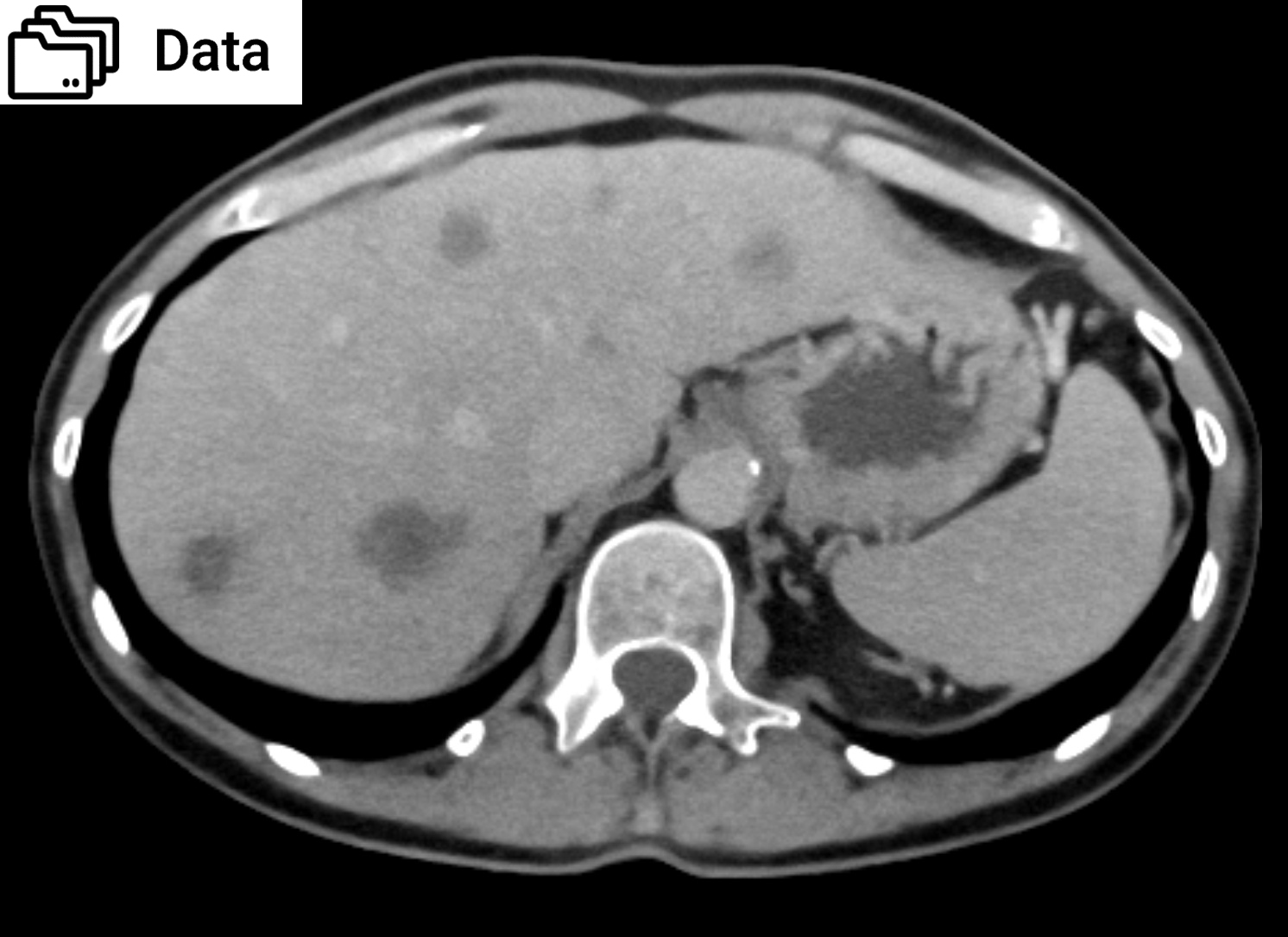 Abdomen phantom liver metastases dataset